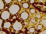 Linear acetylenic carbon